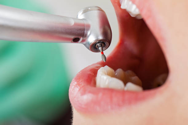Best Emergency Treatment for Dental Infections or Abscesses in Solana, FL